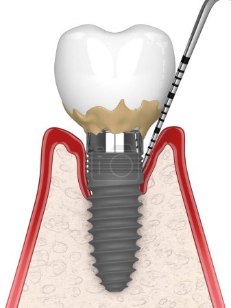 3D renderizado de encías humanas de sección transversal con enfermedad peri implantitis y sonda periodontal sobre fondo blanco