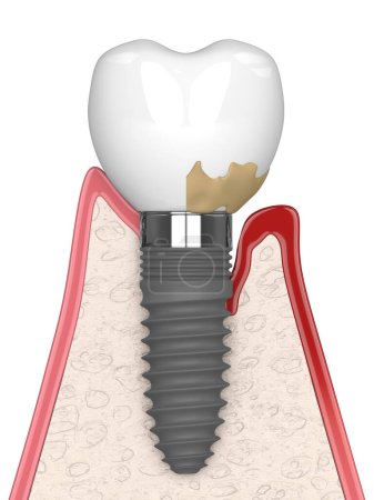 3D renderizado de implante sano versus implante con peri implantitis sobre fondo blanco