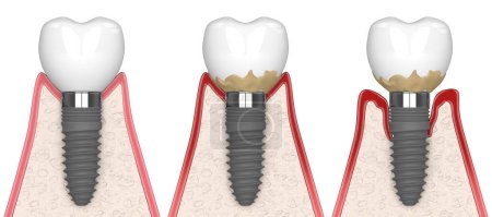 3d render of human gums cross-section with peri implantitis disease process over white background