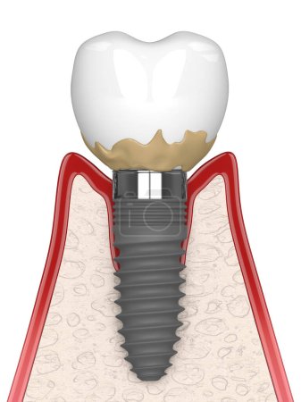 Photo for 3d render of human gums cross-section with peri implantitis disease over white background - Royalty Free Image