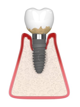 3d render of human gums cross-section with peri implantitis disease over white background