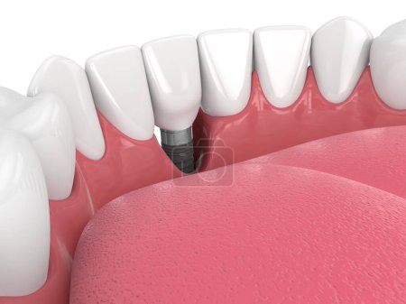 3d render of human jaw with peri implantitis disease over white background