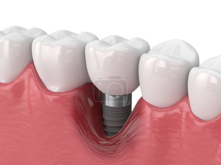 3d render of human jaw with peri implantitis disease over white background
