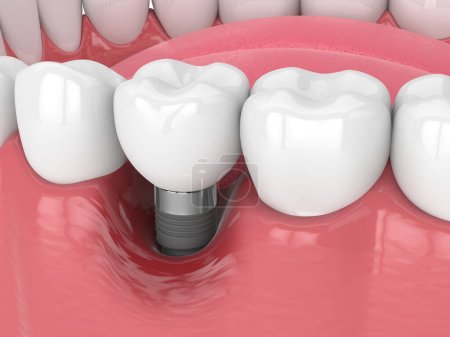 Foto de 3d renderizado de la mandíbula humana con enfermedad de peri implantitis sobre fondo blanco - Imagen libre de derechos