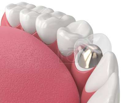 Foto de 3d renderizado de mandíbula inferior con poste fundido y restauración del diente central sobre fondo blanco - Imagen libre de derechos
