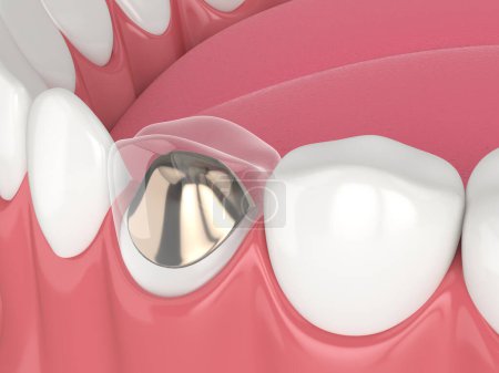 Foto de 3d renderizado de mandíbula inferior con poste fundido y restauración del diente central sobre fondo blanco - Imagen libre de derechos