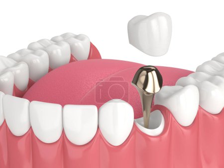 Photo for 3d render of lower jaw with cast post and core tooth restoration over white background - Royalty Free Image
