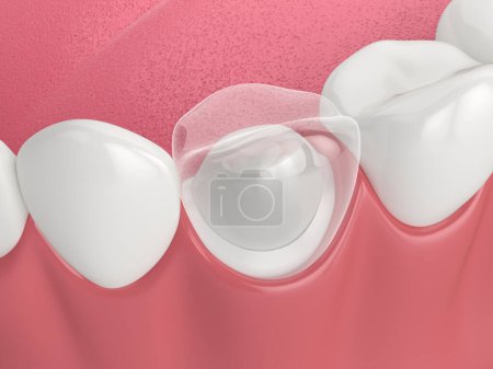 Foto de 3d renderizado de mandíbula inferior con poste dental y restauración del diente central sobre fondo blanco - Imagen libre de derechos
