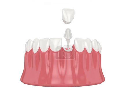 Photo for 3d render of lower jaw with esthetic post and core tooth restoration over white background - Royalty Free Image