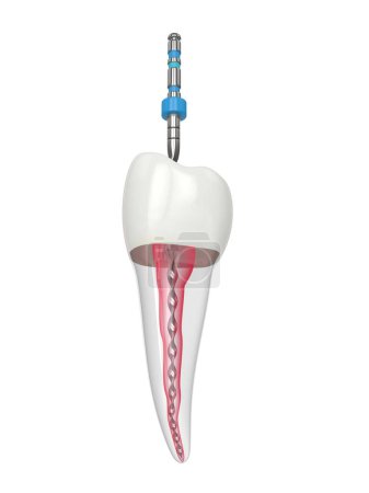 Foto de 3d renderizado de diente premolar con archivo rotatorio endodóntico sobre fondo blanco. Concepto de tratamiento endodóntico. - Imagen libre de derechos