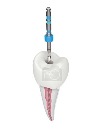 3d renderizado de diente premolar con archivo rotatorio endodóntico sobre fondo blanco. Concepto de tratamiento endodóntico. 