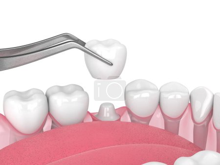 Photo for 3d render of crown replacement on reshaped tooth - Royalty Free Image