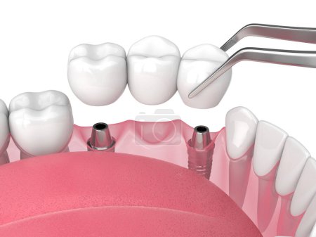 Photo for Jaw with implants supporting dental bridge over white background - Royalty Free Image