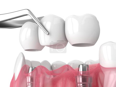 Foto de Mandíbula con implantes que soportan puente dental sobre fondo blanco - Imagen libre de derechos
