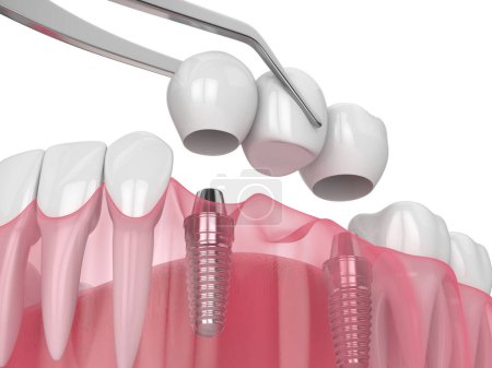 Mandíbula con implantes que soportan puente dental sobre fondo blanco