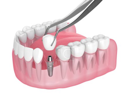 3d render of jaw with dental implant placement over white background