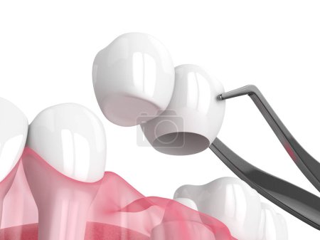 Téléchargez les photos : 3d rendu de mâchoire avec pont cantilever dentaire sur dent encastrée sur fond blanc - en image libre de droit
