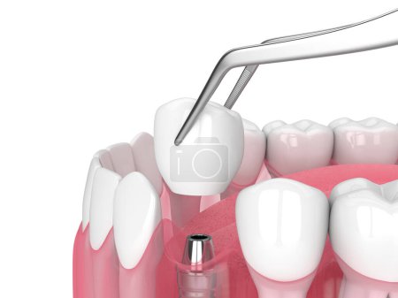 Foto de 3d renderizado de mandíbula con colocación de implantes dentales sobre fondo blanco - Imagen libre de derechos