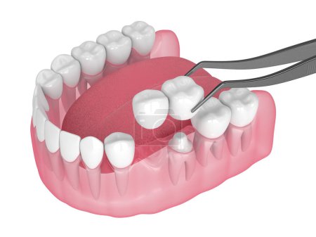 3d renderizado de mandíbula con puente voladizo dental sobre diente incrustado sobre fondo blanco