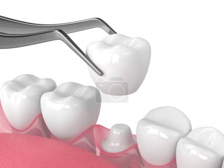 Photo for 3d render of crown replacement on reshaped tooth - Royalty Free Image