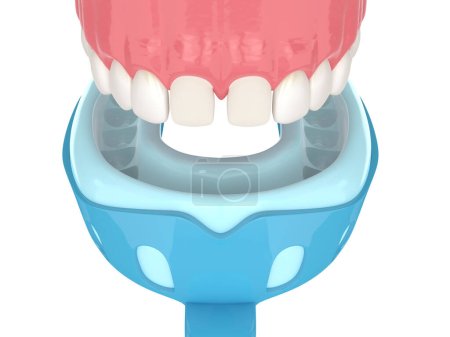 3d render of upper jaw with dental impression tray over white background