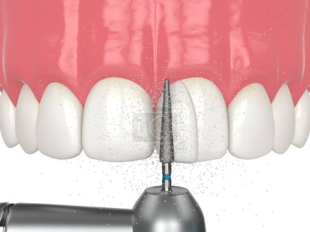Téléchargez les photos : Rendu 3d de la fermeture du diastème en utilisant la procédure de collage. Partie 7. Utiliser une perceuse dentaire pour façonner la dent et éliminer l'excès de résine. Concept de procédure de diastème de clôture. - en image libre de droit