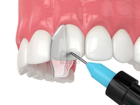 Photo for 3d render of crooked tooth treatment using bonding procedure - Royalty Free Image