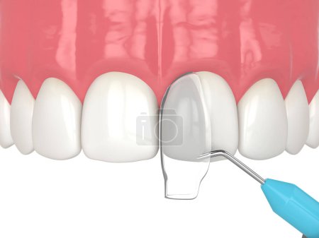 Téléchargez les photos : 3d rendu du traitement des dents tordues en utilisant la procédure de collage - en image libre de droit