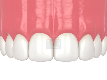 Foto de 3d renderizado de cierre de diastema mediante procedimiento de unión. Parte 9 - Resultado final de la restauración dental mediante el procedimiento de unión. Concepto de procedimiento de diastema de cierre. - Imagen libre de derechos