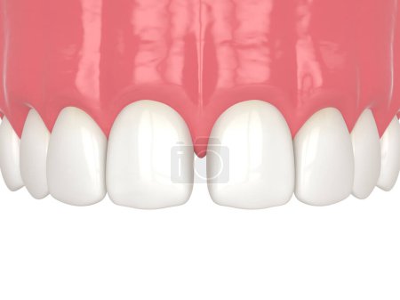 Photo for 3d render of diastema closure using bonding procedure. Part 1. Diastema. Closing diastema procedure concept. - Royalty Free Image
