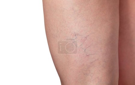 Foto de Venas varicosas y venas capilares en las piernas. Inspección médica y tratamiento de Telangiectasia. - Imagen libre de derechos