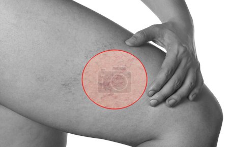 Photo for Man shows hand seat with the dilation of small blood vessels of the skin on the leg. Medical inspection and treatment of Telangiectasia.photo in black and white. - Royalty Free Image