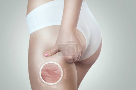 Foto de La mujer muestra celulitis en el muslo. Tratamiento de la obesidad. - Imagen libre de derechos