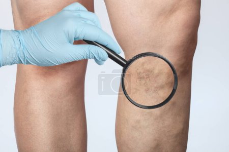 Téléchargez les photos : Médecin montre la dilatation des petits vaisseaux sanguins de la peau sur la jambe. Inspection médicale et traitement de la télangiectasie, cosmétologie - en image libre de droit