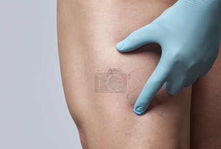 Téléchargez les photos : Médecin montre la dilatation des petits vaisseaux sanguins de la peau sur la jambe. Inspection médicale et traitement de la télangiectasie. - en image libre de droit