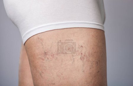 Foto de La dilatación de pequeños vasos sanguíneos de la piel en la pierna. Inspección médica y tratamiento de Telangiectasia. - Imagen libre de derechos