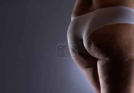 Foto de Mujer gorda con depósitos de grasa y celulitis en las nalgas y muslos. Tratamiento del sobrepeso y la celulitis, concepto de cosmetología. - Imagen libre de derechos