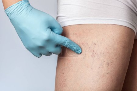 Photo for Doctor shows  the dilation of small blood vessels of the skin on the leg. Medical inspection and treatment of Telangiectasia. - Royalty Free Image
