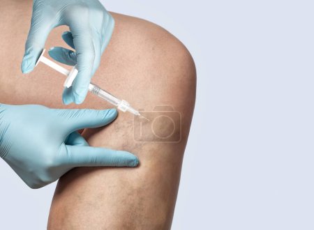 Photo for A doctor does medical procedure Sclerotherapy to eliminate varicose veins and spider veins. An injection of a solution directly into the vein. - Royalty Free Image