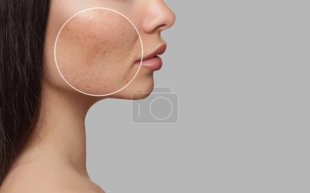 Photo for Photo before and after treatment for acne. A young girl with a problem skin. Skin treatments. Cosmetology and professional skin care. - Royalty Free Image