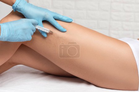 Téléchargez les photos : Enlèvement des varices sur les jambes. Inspection médicale et traitement de la télangiectasie. Phlébeurisme. - en image libre de droit