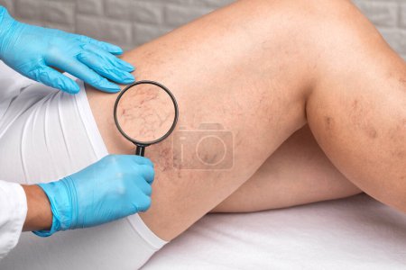 Photo for Doctor shows  the dilation of small blood vessels of the skin on the leg. Medical inspection and treatment of Telangiectasia. Phlebeurysm. - Royalty Free Image