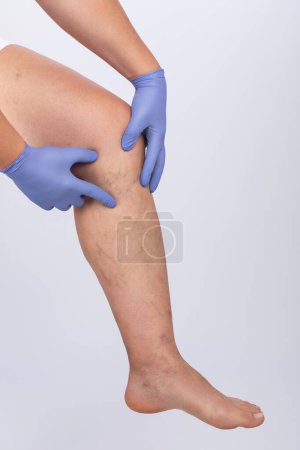 El hombre con guantes azules muestra la dilatación de pequeños vasos sanguíneos de la piel en la pierna. Inspección médica y tratamiento de Telangiectasia. Flebeurismo.