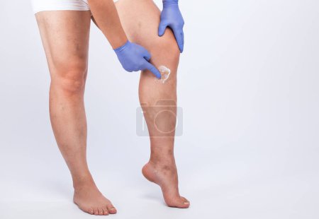 Photo for Man in blue gloves shows  the dilation of small blood vessels of the skin on the leg. Medical inspection and treatment of Telangiectasia. Phlebeurysm. - Royalty Free Image