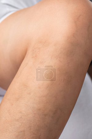 Téléchargez les photos : Médecin montre la dilatation des petits vaisseaux sanguins de la peau sur la jambe. Inspection médicale et traitement de la télangiectasie. Phlébeurisme. - en image libre de droit