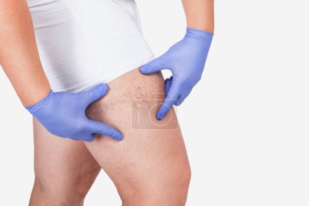 Foto de El hombre con guantes azules muestra la dilatación de pequeños vasos sanguíneos de la piel en la pierna. Inspección médica y tratamiento de Telangiectasia. Flebeurismo. - Imagen libre de derechos