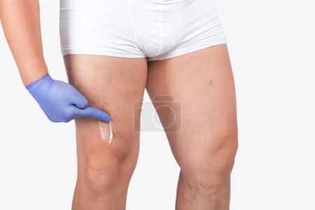 Un hombre se aplica ungüento en la pierna. Tratamiento con malla capilar. Phlebeurysm. Inspección médica y tratamiento de Telangiectasia.