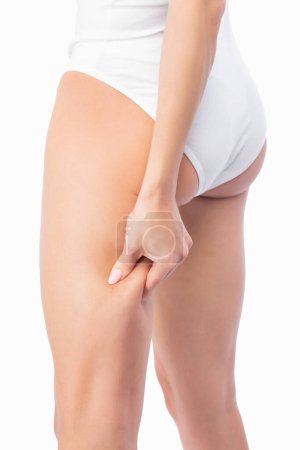 Foto de La niña estira la piel de la pierna, mostrando depósitos de grasa. Tratamiento y eliminación del exceso de peso, depósito de grasa subcutánea. - Imagen libre de derechos