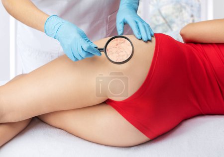 Foto de Médico muestra la dilatación de pequeños vasos sanguíneos de la piel en la pierna. Inspección médica y tratamiento de Telangiectasia. Flebeurismo. - Imagen libre de derechos