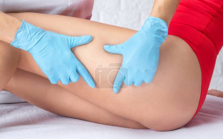 Der Arzt zeigt die Erweiterung kleiner Blutgefäße der Haut am Bein. Medizinische Untersuchung und Behandlung von Telangiektasien. Phlebeurysmus.